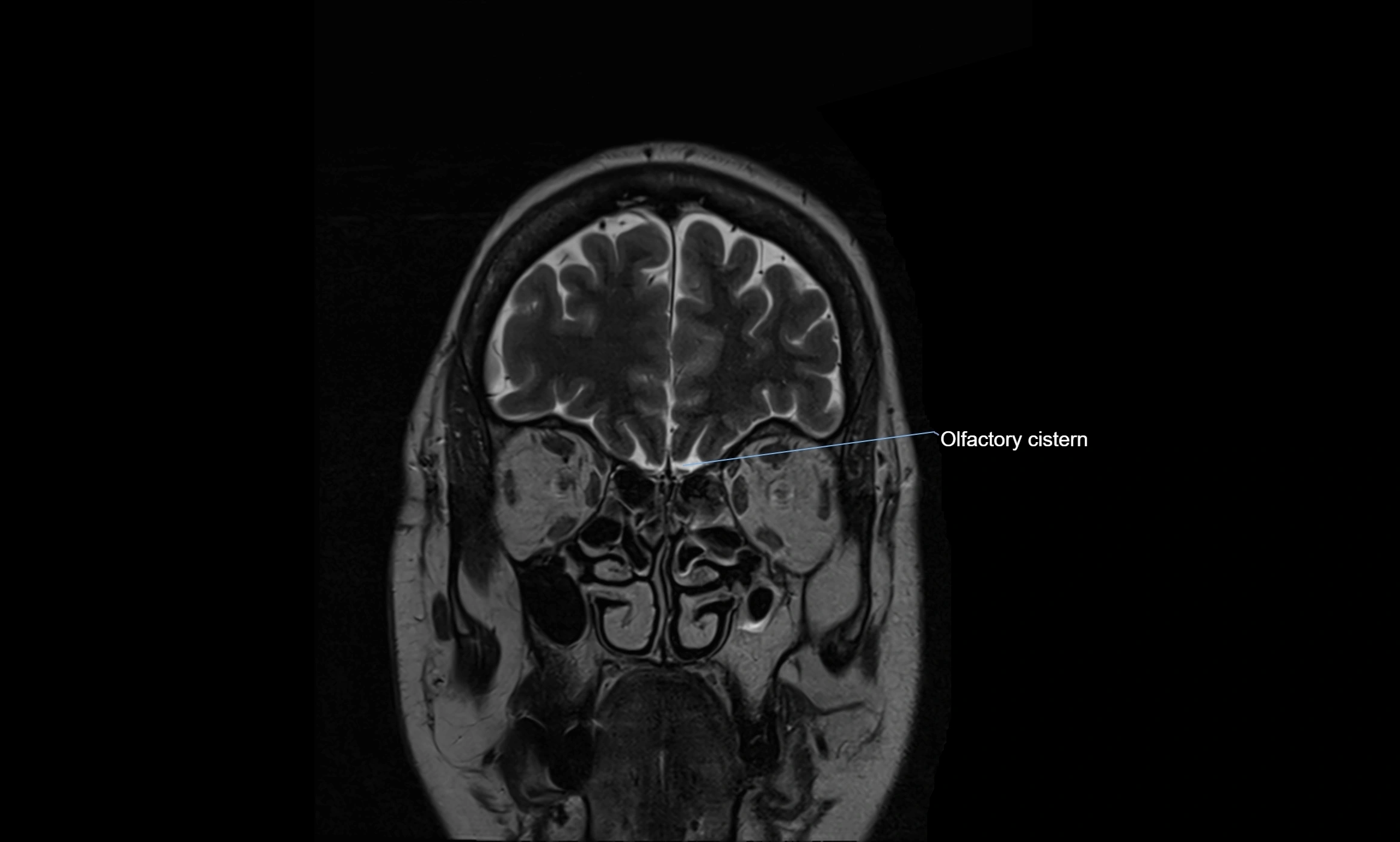 Brain cisterns  and ventricles coronal anatomy 3T MRI image-img-00001-00006.webp